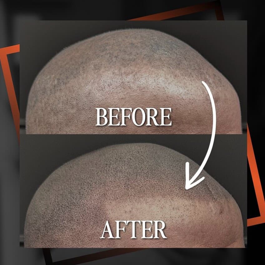 Buzz cut hair tattoo before and after Toronto — The Black Light
