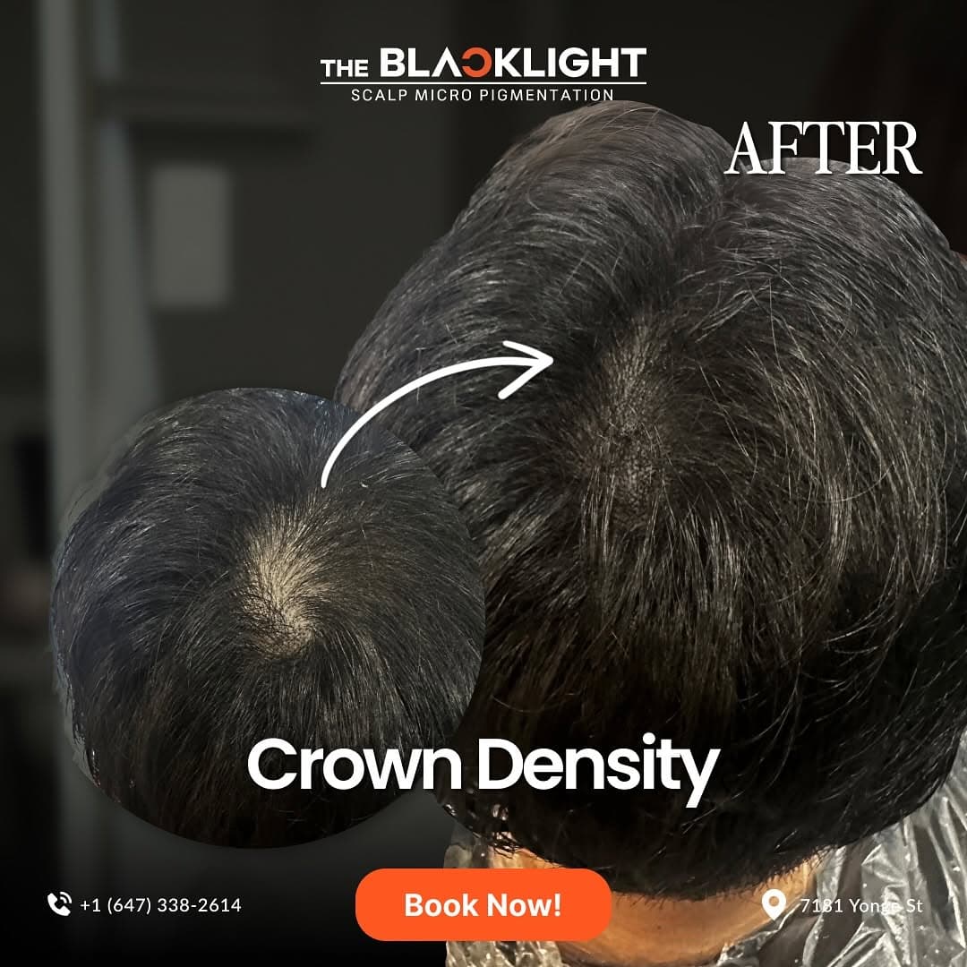 Hair tattoo crown density before and after Toronto — The Black Light
