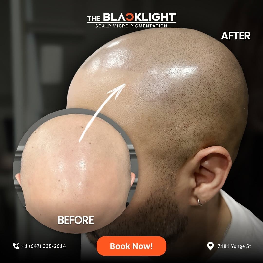SMP treatment results Toronto — The Black Light