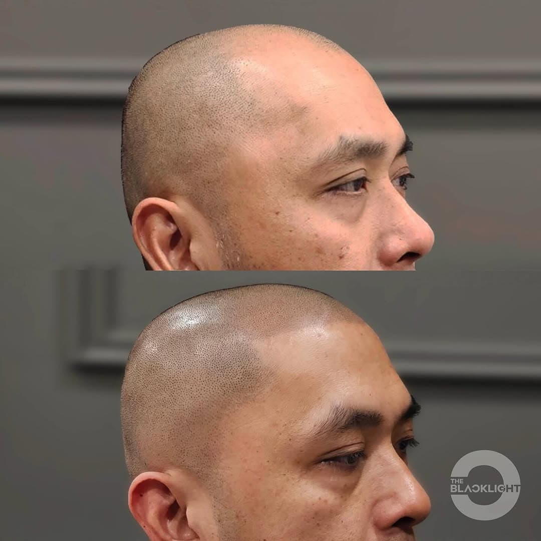 Hair tattoo for men before and after Toronto — scalp micropigmentation at The Black Light