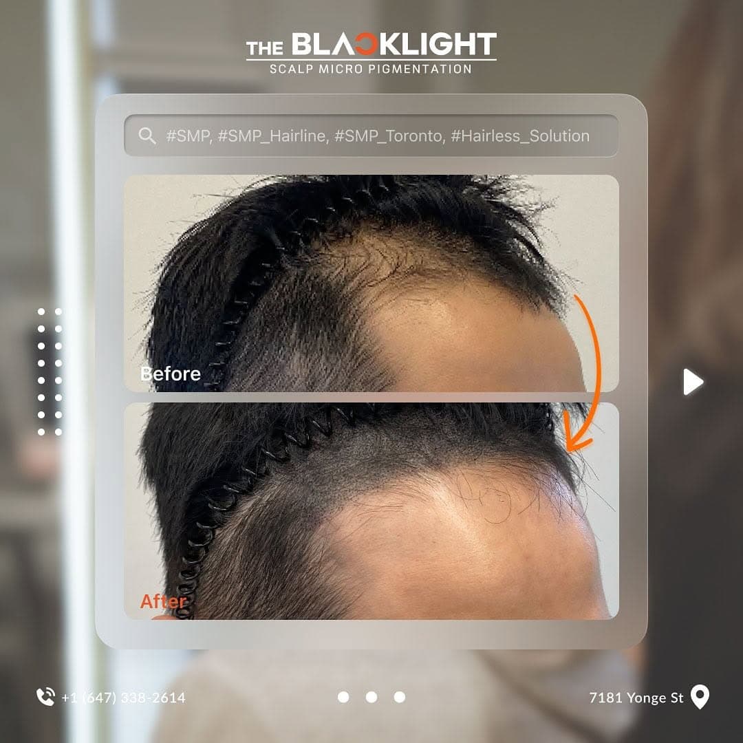 SMP hairline restoration before and after Toronto — The Black Light
